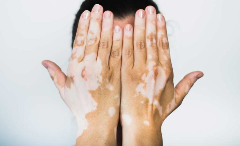  Día del Vitiligo Mundial: una fecha para hacer visible, comprender y acompañar

 – Panorama 24
