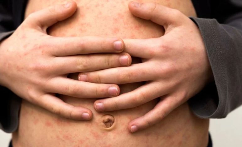  Identifican caso de sarampión en Bucaramanga

 – Panorama 24